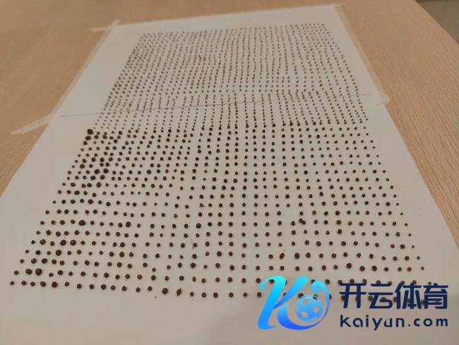男人体内发现1791颗结石