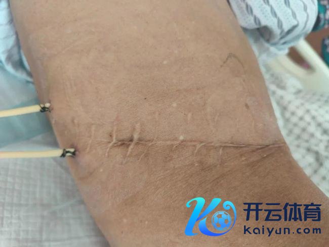 男人体内发现1791颗结石 结石王国惊现肾脏